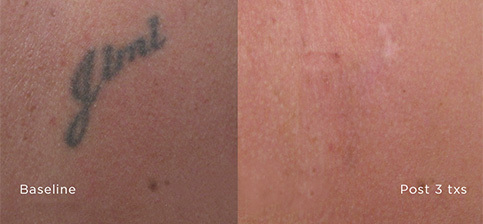 Laser Tattoo Removal Seattle | Seattle's Most Advanced Laser